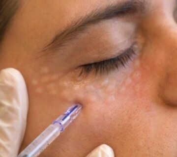 تزریق اگزوزوم تیرگی دور چشم