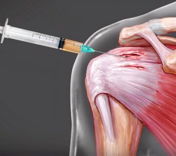 اگزوزوم درمانی شانه یخ زده